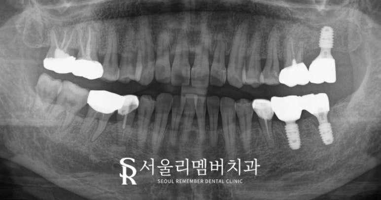 살리려던 어금니, 신경치료 시도 후 결국 임플란트로 복구한 보라매 치과 치료 사례 관련 이미지 8