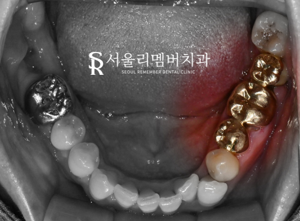 기존 브릿지 주변이 욱신거리고 아파요.. 왜 그런 걸까요? 신대방 치과 임플란트 증례 관련 이미지 1