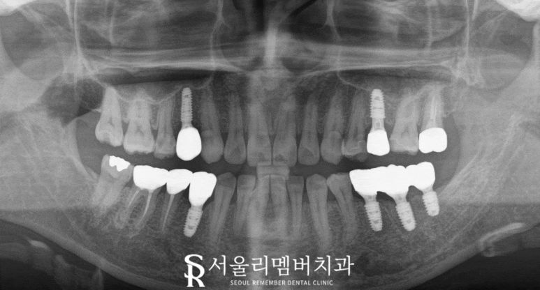 신림 치과 신경치료와 임플란트 어떤 기준으로 결정하게 되는지 궁금하다면 <클릭> 관련 이미지 5