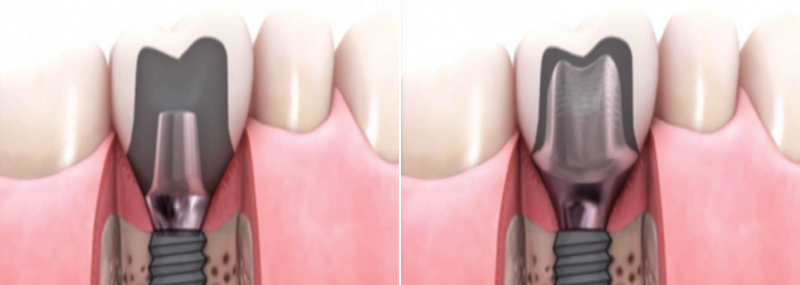 맞춤형 지대주 (customized abutment)는 뭐가 좋은 걸까요? 봉천동 서울 리멤버 치과 관련 이미지 1