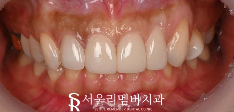 기존 라미네이트에 틈과 변색이 생겼다면? 낙성대 치과 상악 4전치 리얼네이트로 다시 완성한 앞니 관련 이미지 5