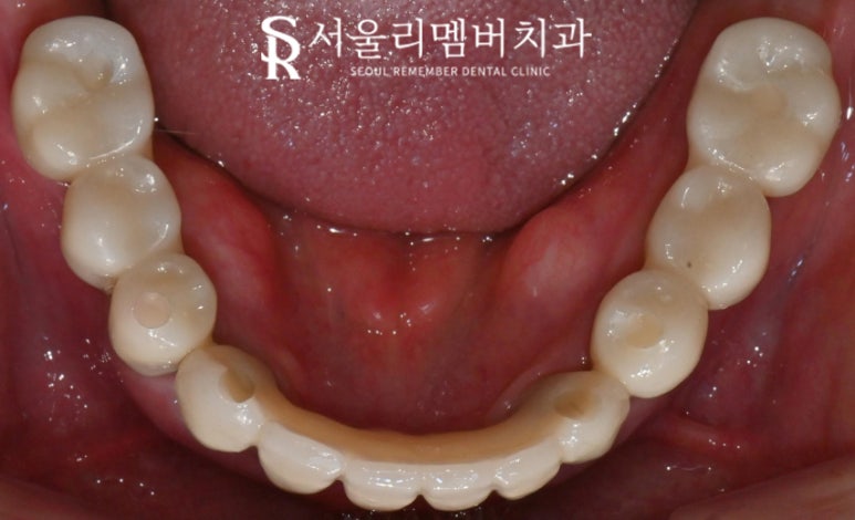 서울대입구역 치과 에서 수면(의식하진정)요법 동반한 전체 임플란트 식립 관련 이미지 8