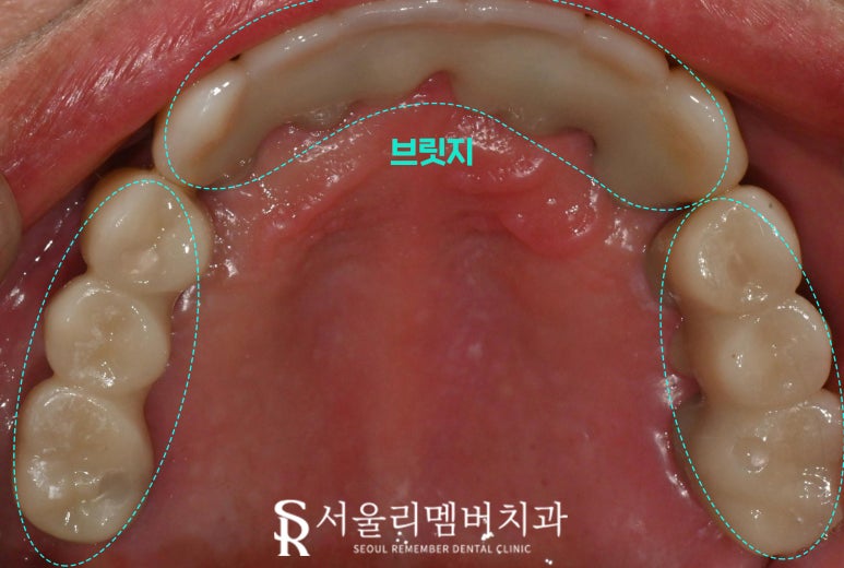 과잉진료 없는 보라매 치과 에서 최소 개수 전악 임플란트 식립 관련 이미지 7