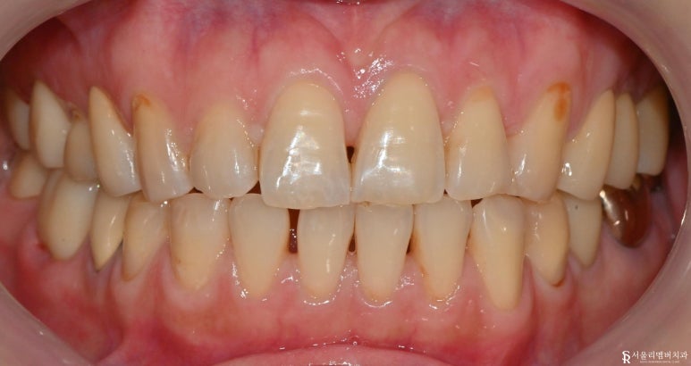 곳곳에 많은 충치, 신림역 치과 에서 앞니 심미 레진 치료와 어금니 지르코니아 크라운 치료 관련 이미지 5