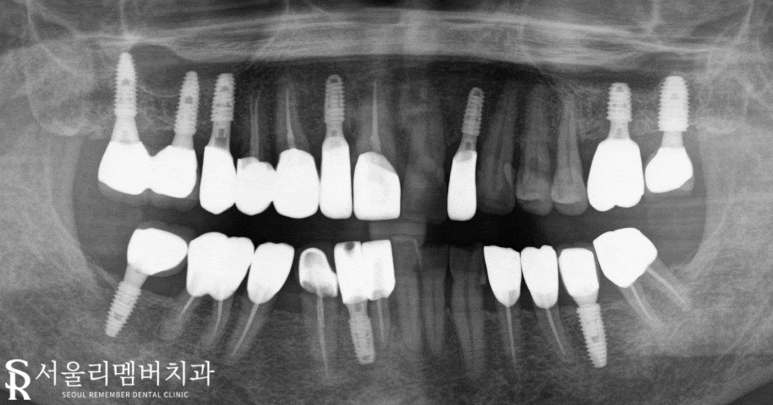 상도동 치과 다수의 충치, 임플란트와 신경치료 한 사례 (치경부 치석 관리의 중요성) 관련 이미지 5