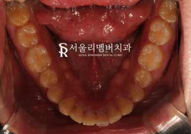 상도동치과 에서 발치 없이 깊게 물리는 과개교합 및 2급 부정교합 개선! 관련 이미지 6