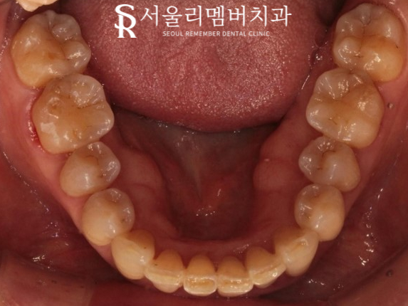 40대 교정 지금 시작해도 늦지 않을까요? 서울대입구역 치과 관련 이미지 14