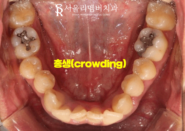 서울대입구역 치과 에서 들쑥날쑥 했던 치열, 비발치로 개선해 드렸습니다. 관련 이미지 3