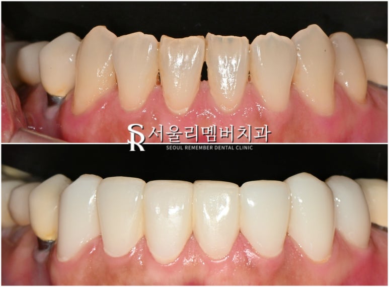 Improving Spaces Between the Front Teeth and Dark Staining from Discolored Resin at the Same Time: Anterior Laminate Veneers and Realnate at Seoul National University Entrance Station Dental Clinic image 5