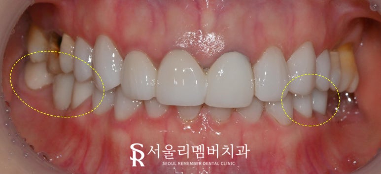 서울대입구역 치과 에서 오래된 어금니 브릿지 지르코니아 크라운 으로 교체해서 심미성 되찾아드렸습니다. 관련 이미지 3