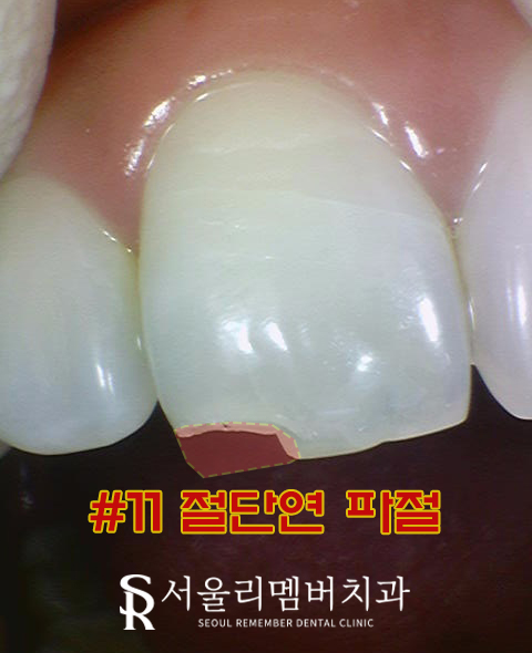 신림 치과 앞니 끝 절단연 깨짐 30분 만에 당일 파절 치아 레진 치료 관련 이미지 1