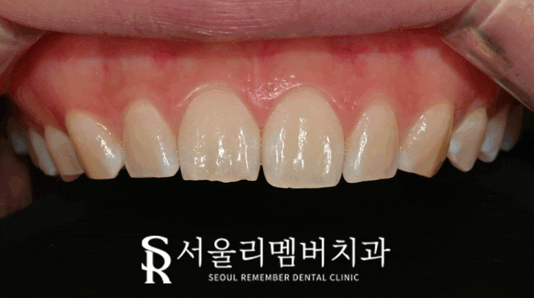 신림역 치과 앞니 끝부분 깨짐 절단연 파절 레진으로 티 안 나게 하루 만에 당일 치료 관련 이미지 1