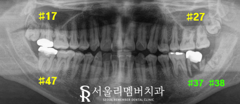 사당역 치과 신경치료와 임플란트로 건강한 치아 되찾기 관련 이미지 1