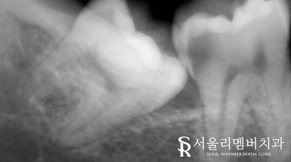 관악구 치과 원인을 알 수 없는 치통, 매복되어 있는 사랑니 때문? 관련 이미지 1