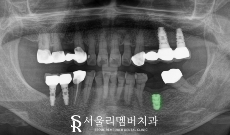 신림역 치과 오스템 BA 임플란트 당일 수술로 빠져버린 어금니 회복 관련 이미지 3