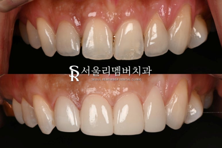 기존 라미네이트에 틈과 변색이 생겼다면? 낙성대 치과 상악 4전치 리얼네이트로 다시 완성한 앞니 관련 이미지 6