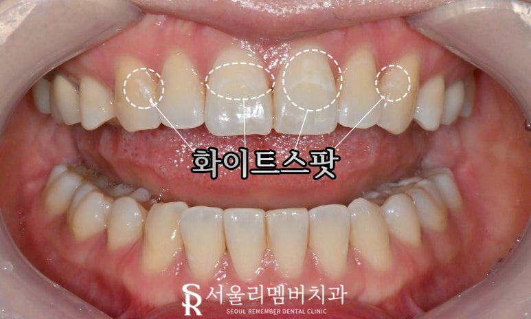 신림역 치과 상악 6전치 리얼네이트 초기 충치 화이트스팟 반점치 라미네이트로 우식 제거 후 보철 수복 과정 관련 이미지 2