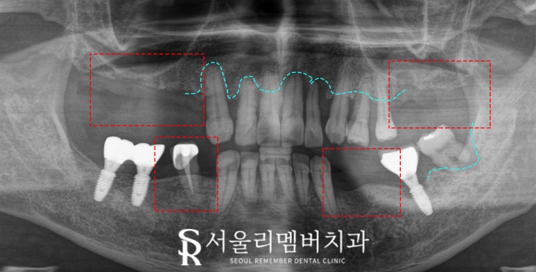 서울대입구역 치과 "부분틀니에서 임플란트로" 바꿔서 전악 개선해 드린 증례 관련 이미지 1