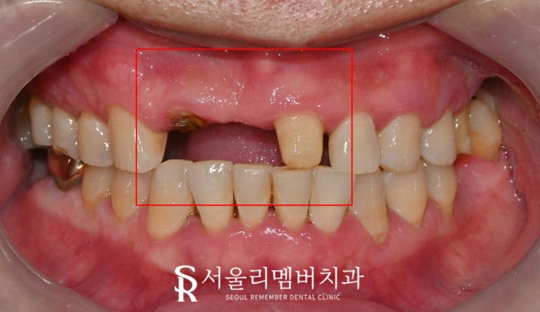서울대입구 치과 환한 웃음을 되찾는 여정: 앞니 브릿지 탈락부터 임플란트를 통한 새로운 미소까지 관련 이미지 3