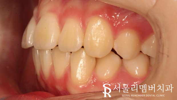 인비절라인을 사용한 치아 총생 개선 증례! 청룡동 치과 관련 이미지 3
