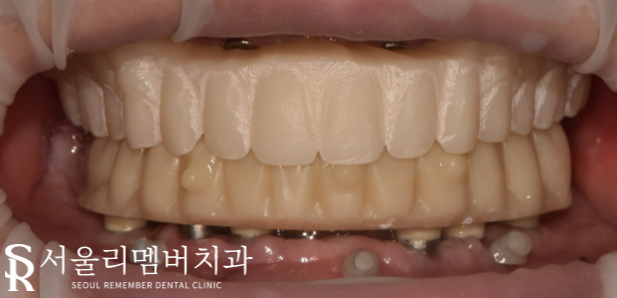 오랜 틀니 착용으로 잇몸이 다 망가졌던 분.. 임플란트 식립으로 밝은 미소 되찾아드렸습니다! 서울대입구역 서울 리멤버 치과 관련 이미지 6