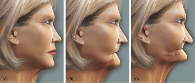 서울대입구역 치과 무너진 수직 고경 어떻게 개선했을까? 관련 이미지 1