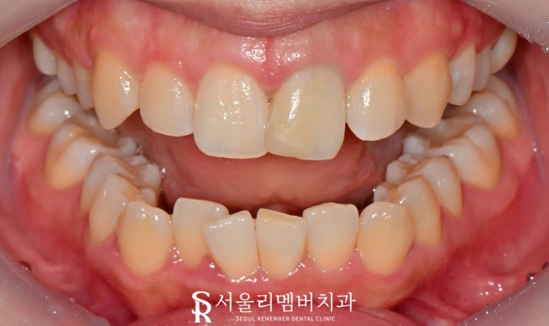교정이 부담스러운데 치아 삐뚤빼뚤 총생 있다면 봉천역 치과 전치부 리얼네이트와 앞니 크라운 관련 이미지 2