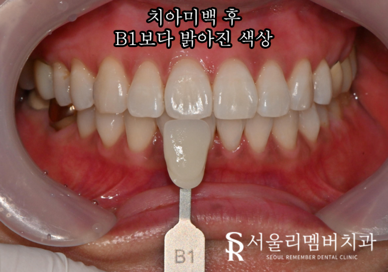 서울대입구역 치과 연말 모임 행사 준비의 시작은 원데이 치아미백 관련 이미지 4