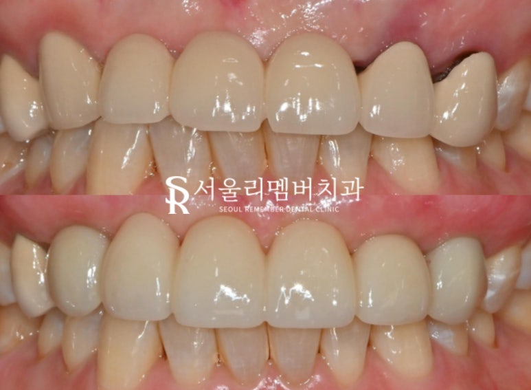 상악 전치부 임플란트 후 고퀄리티 심미보철 로 자신감 되찾으세요! 관련 이미지 5