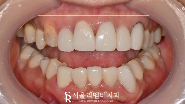 Nakseongdae Dental Clinic: If a front tooth laminate veneer falls off, can’t it just be reattached? Anterior crowns and Realnate re-prosthetics image 3
