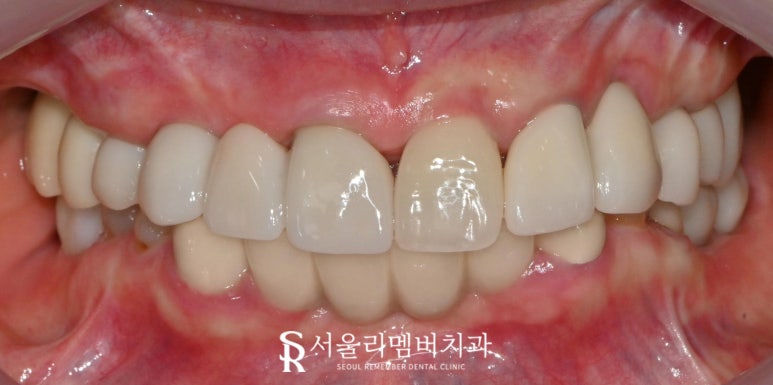 잇몸뼈 소실 다수의 치아 서울대입구역 치과 에서 전체 임플란트 브릿지 수술 진행 관련 이미지 6