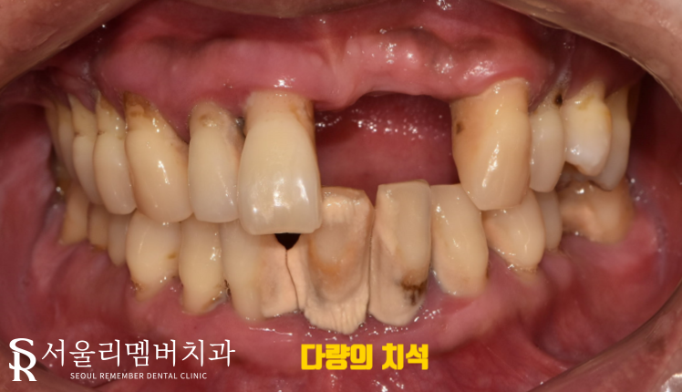 치석이 발치로 이어질 수 있다는 말, 사실일까요?! 봉천동 서울 리멤버 치과 관련 이미지 2