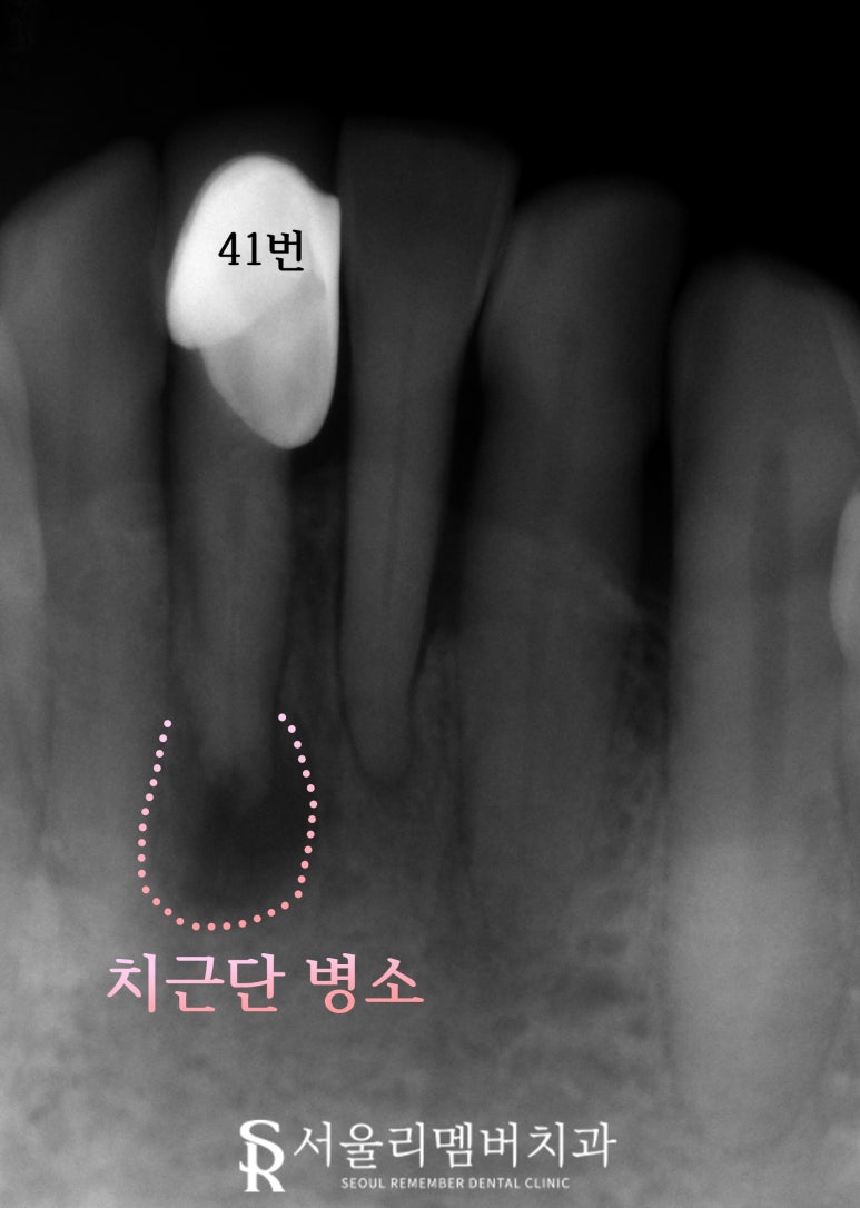 신림 치과 오래된 아래 앞니 PFM 크라운 치경부 금속 비침과 치근단 병소로 신경치료 후 지르코니아 심미보철 수복 관련 이미지 3