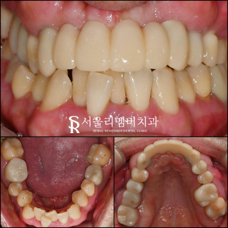 보라매 치과 무너지고 상실된 치아 반드시 신속한 임플란트 해야 됩니다. 관련 이미지 4