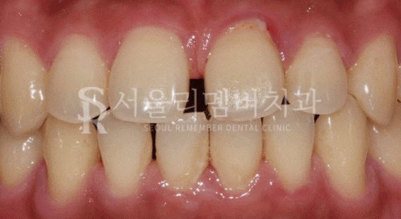 벌어진 치아, 사당 치과 인비절라인으로 개선할 수 있을까? 관련 이미지 1