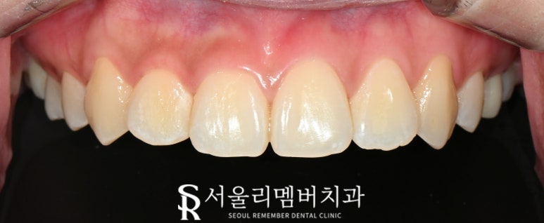 사당역 치과 리얼네이트 심미보철 라미네이트로 누렇고 약한 앞니부터 작은 어금니까지 변화 관련 이미지 3