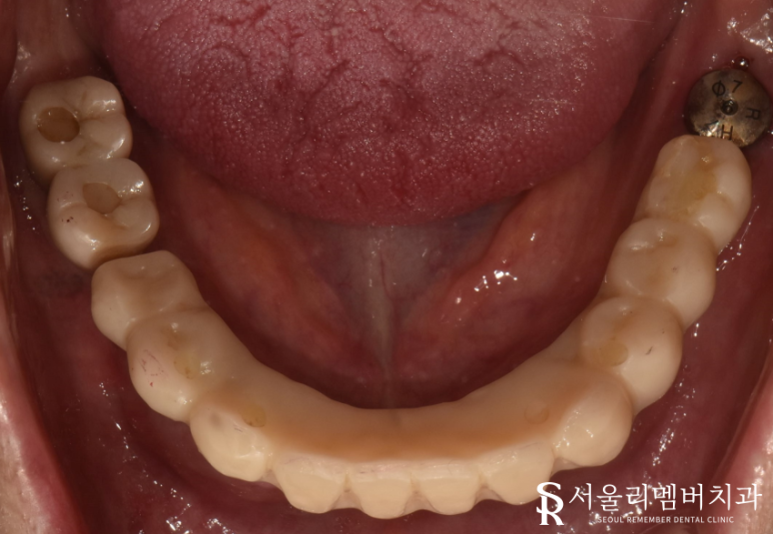 빠져버린 치아 그대로 내버려 두면 안모변형을 초래할 수 있습니다! 신림역 서울 리멤버 치과 관련 이미지 8