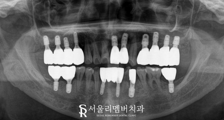 서울대입구역 치과 발치 즉시 다수 네비게이션 임플란트 식립 결과는? 관련 이미지 3