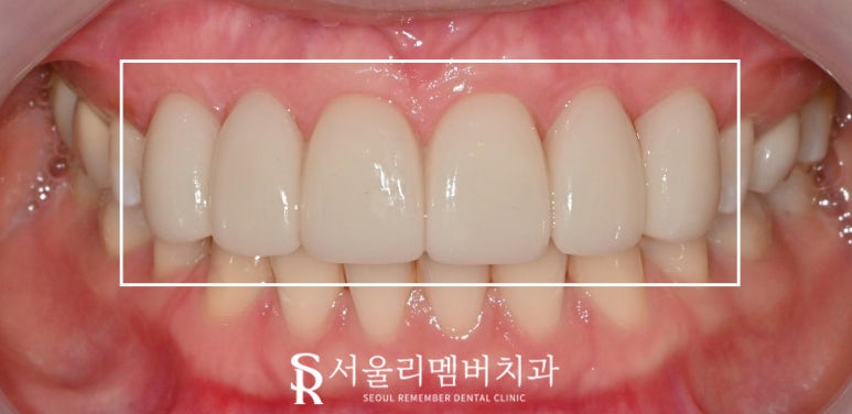 신림역 치과 상악 6전치 리얼네이트 초기 충치 화이트스팟 반점치 라미네이트로 우식 제거 후 보철 수복 과정 관련 이미지 5