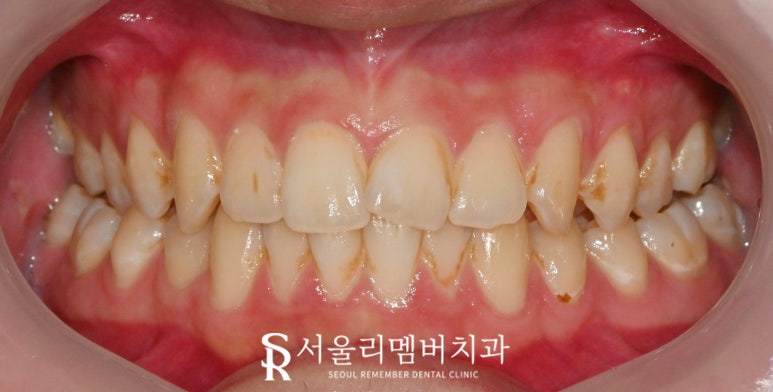 서울대입구 치과 연 1회 보험 스케일링으로 착색 제거 및 잇몸 건강 지키기 관련 이미지 1