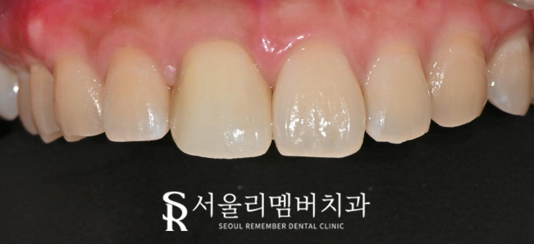 서울대입구역 치과 앞니 임플란트 보철 디자인 생김새 모양 마음에 안 들 때 수정할 수 있을까? 관련 이미지 2