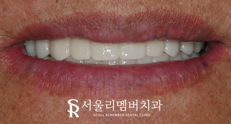 보라매 치과 에서 틀니에서 수면마취 전악 임플란트로 전체 치아 기능 회복 관련 이미지 9
