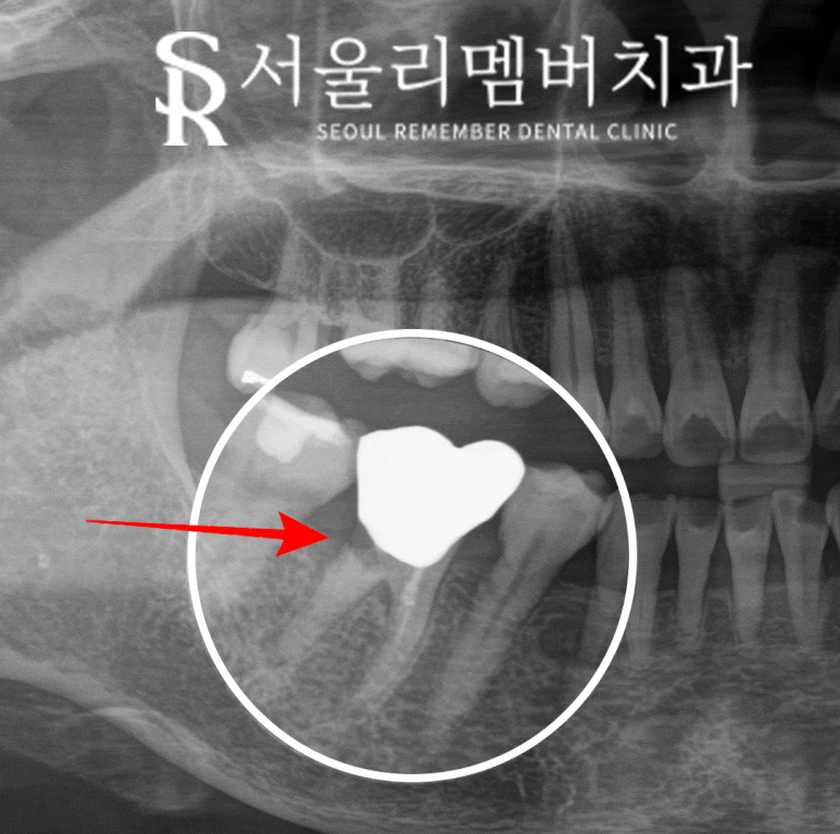 Root Fracture Caused by Secondary Decay Under a Gold Crown, Immediate Implant After Extraction at Sadang Station Dental Clinic image 3