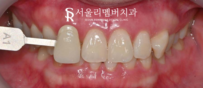 누런치아 되돌리는 뚜렷한 효과! 치아미백 잘하는 서울대입구역 치과 관련 이미지 2