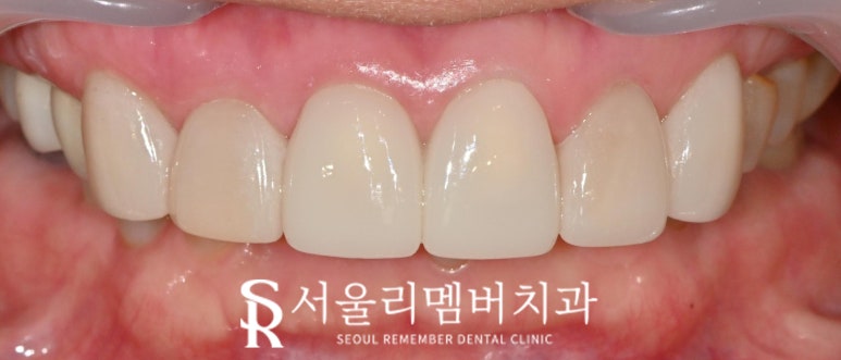 오래된 크라운 경계 불량, 이차 충치, 치경부 마모증은 앞니 라미네이트 적응증 봉천동 치과 의사 작성 관련 이미지 5