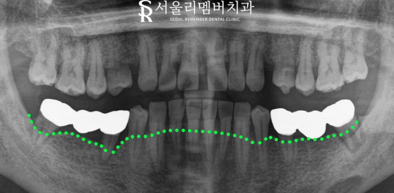 "오래된 크라운 있는 쪽으로 아파서 밥을 못 먹어요." 보라매 치과 임플란트 및 신경치료 후기 관련 이미지 2
