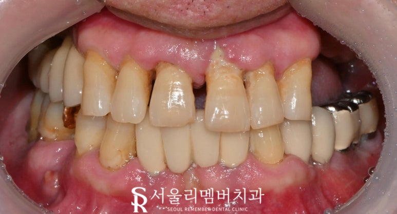 서울대입구역 치과 에서 최소 비용으로 다수 임플란트 브릿지 크라운 진행한 케이스 관련 이미지 1