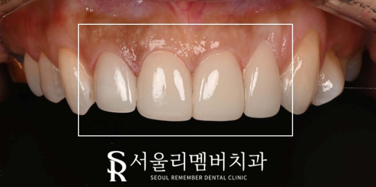 기존 라미네이트에 틈과 변색이 생겼다면? 낙성대 치과 상악 4전치 리얼네이트로 다시 완성한 앞니 관련 이미지 4