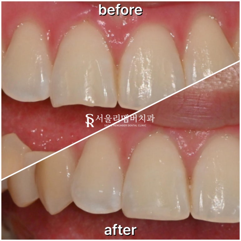 사당역 치과 깨진 앞니, 당일 레진 수복으로 비용 부담 없이 하루 만에 가능 관련 이미지 3