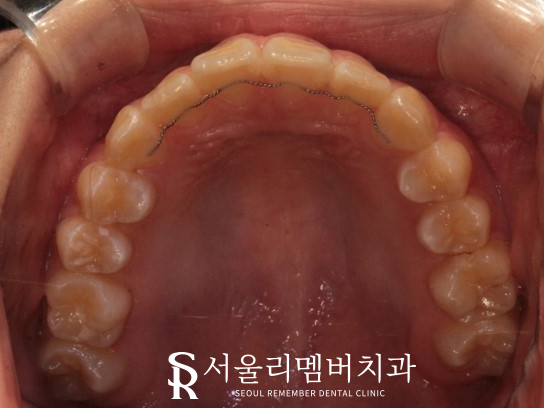 인비절라인을 사용한 치아 총생 개선 증례! 청룡동 치과 관련 이미지 14